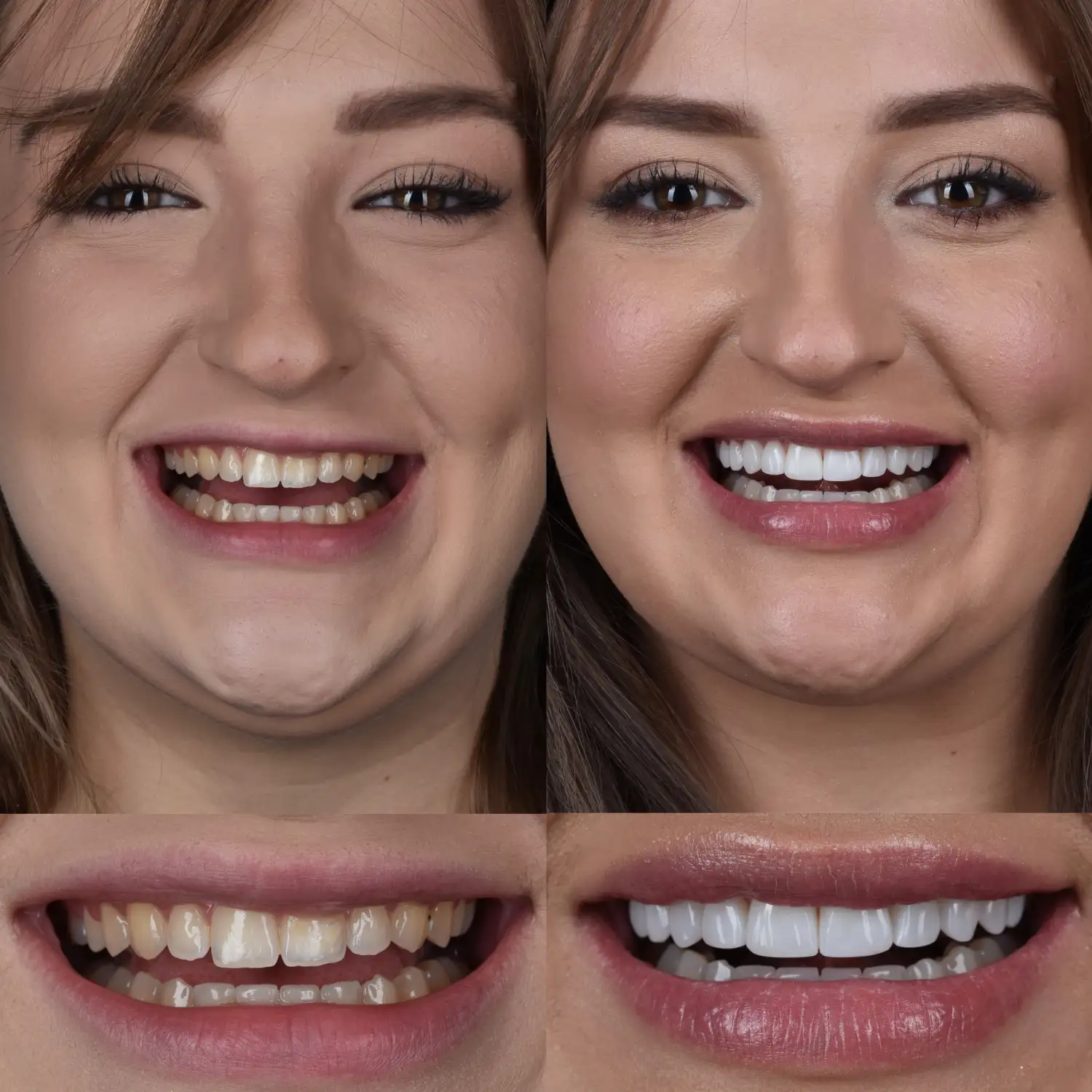 Przed i po metamorfozie uśmiechu metodą bondingu wykonanej w Unident Union. Natalia Oleś z nowym, białym i estetycznym uśmiechem.