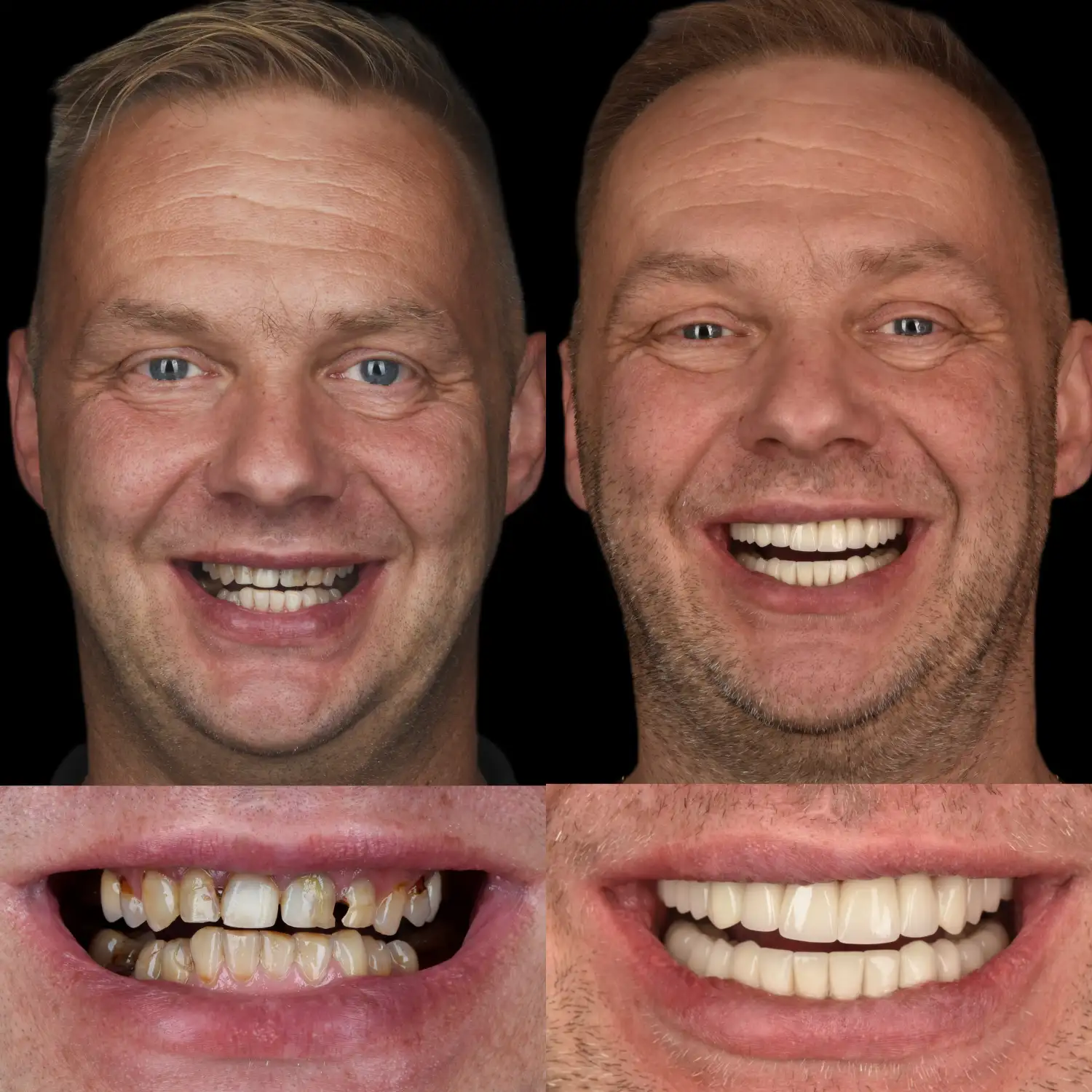 Nowoczesne leczenie chorób dziąseł i przyzębia w Unident Union. Profesjonalna opieka periodontologiczna dla zdrowego uśmiechu.